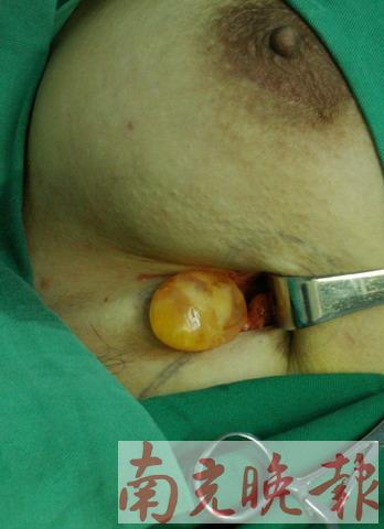 女子爱美 隆胸弄出个“金蛋”